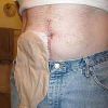 Colostomy Bags
