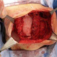 Hernia Kit