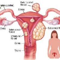 Fibroid Treatment