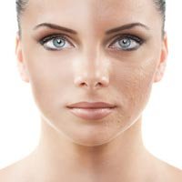 Glycolic Acid Peels