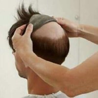 Baldness Treatment