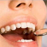 Teeth Filling Services