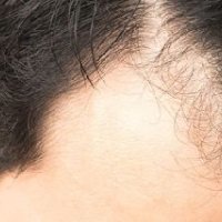 Alopecia Areata Treatment Services