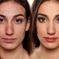 Scar Treatment