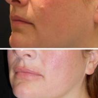 Mole Removal