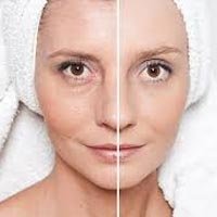 Face Lift Surgery