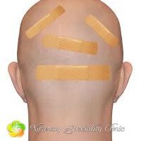 Fue Hair Transplant Service