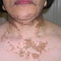 Vitiligo Treatment Services