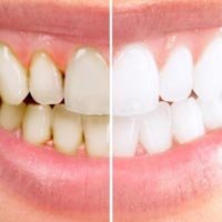 Teeth Scaling