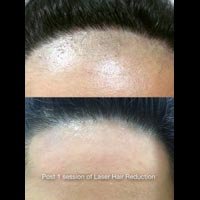 Laser Hair Treatment