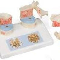 Osteoporosis Model