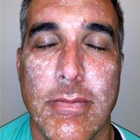 Chemical Peel
