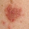 Eczema Treatment Services