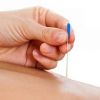 Acupuncture Therapy