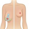 Breast Lift Surgery