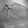 Coronary Angiography