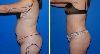 Liposuction Surgery in Mandi