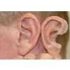 Silicone Ear Prosthesis