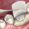 Collagen Bone Graft