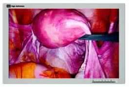 Foreseeson full HD surgical display