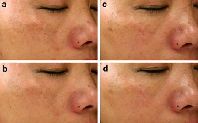 Skin Disease Neurotherapy Treatment