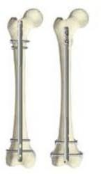 Stainless Steel Polished Femur Nail, for Hospital, Feature : Disposable, Easy To Use, High Quality