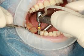 0-10gm dental implants, for Lab Use