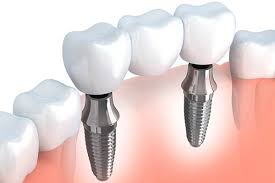  0-10gm dental implants, for Lab Use