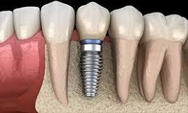  0-10gm dental implants, for Lab Use