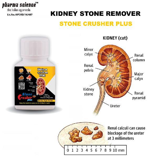 Kidney Stone Ayurvedic Medicine
