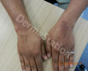 Allergic Contact Dermatitis Treartment