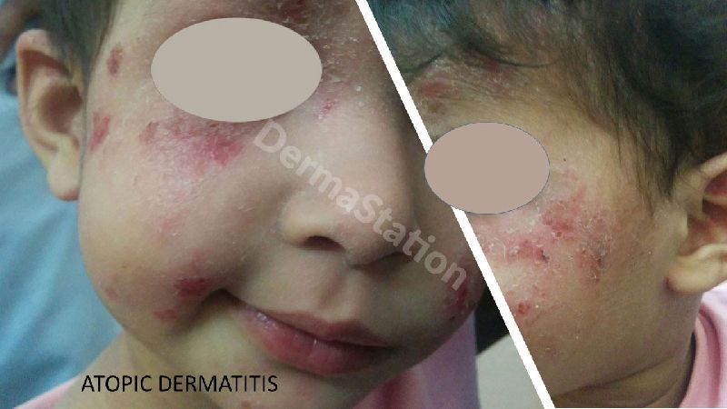 Atopic Dermatitis Treatment