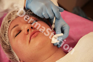 Botulinum Toxin (Botox) Treatment