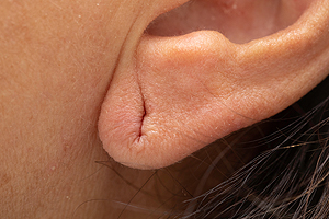 Ear Lobe Repair Treatment