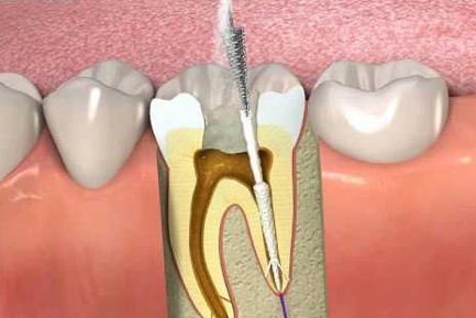 Root Canal Treatment Services