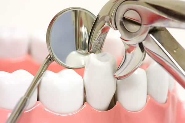 Tooth Extraction Treatment Services