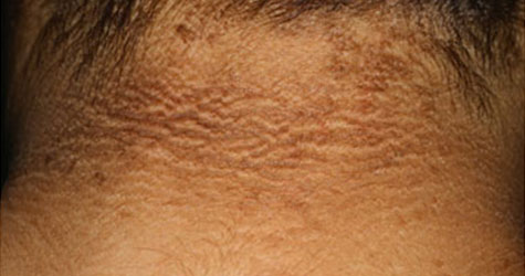 Acanthosis nigricans Treatment