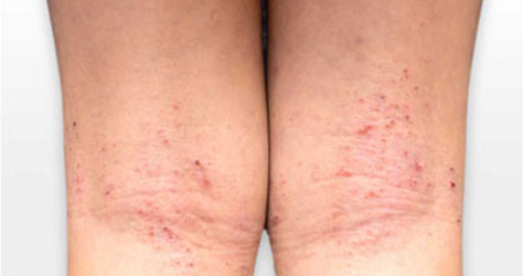 Atopic Dermatitis Infection Treatment