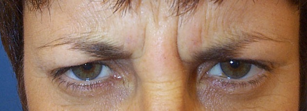 Botulinum Toxin for Frown Lines