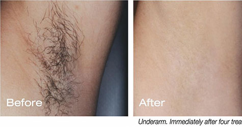 Laser Hair Removal Treatment