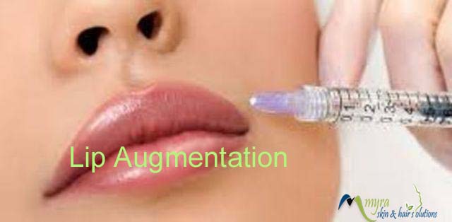 Lip Augmentation Treatment