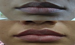 Lip Colouring Treatment
