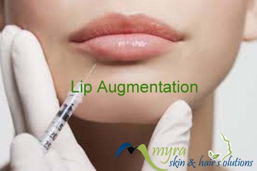 Lip Enhancement