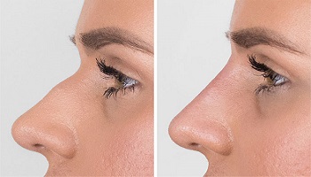Nose Filler Treatment