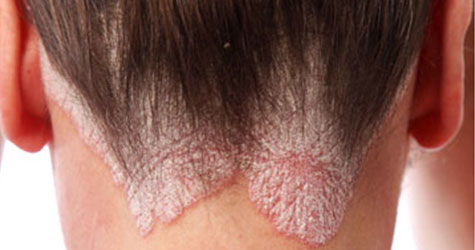 Psoriasis Infection Treatment