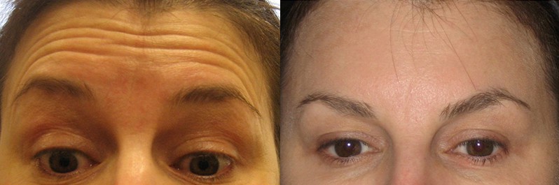 Rid of Forehead Lines