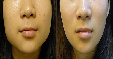 Slimmer Face Treatment