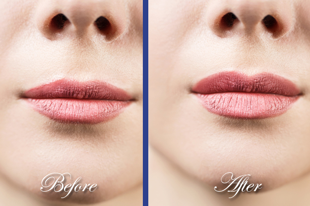 Lip Reduction Services