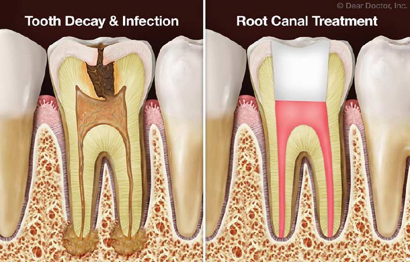 Root Canal Treatment Services