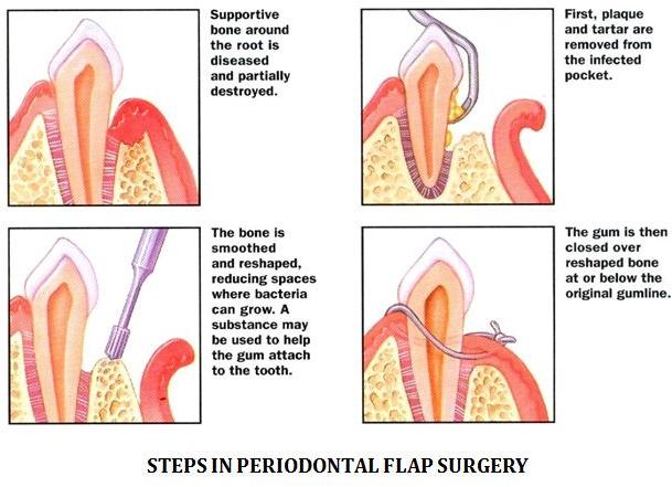 Flap Surgery Treatment Services